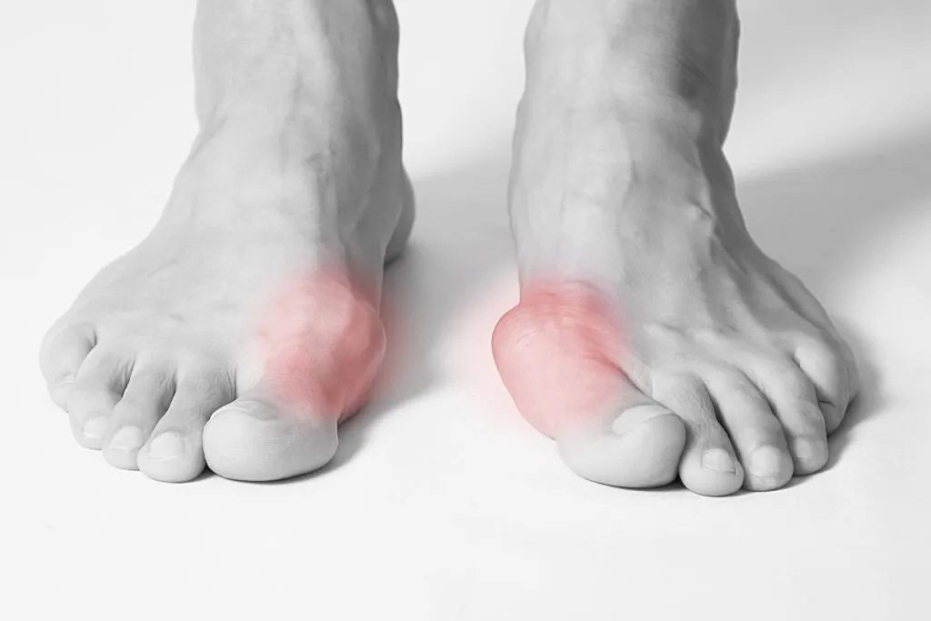 Cirugía PAD de Hallux Valgus (juanete): beneficios del Bono PAD y procedimiento bunion 1024x683